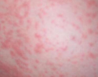 亚急性湿疹引起原因是什么