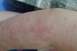 湿疹的皮肤病通过按摩有效果